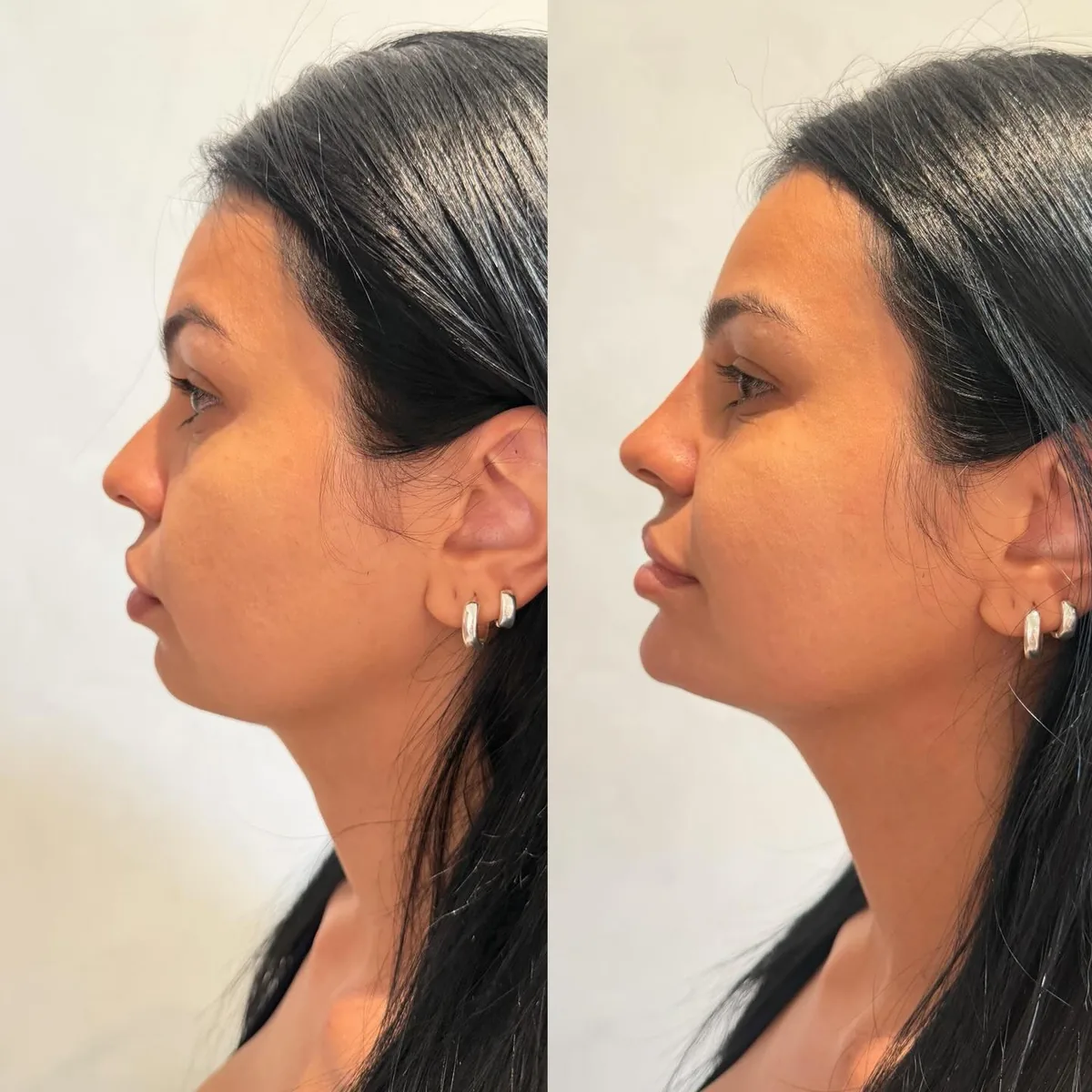 Registro publicado por Isabella sobre perfiloplastia